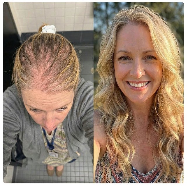 Before and after — crown filling back in after FORMA