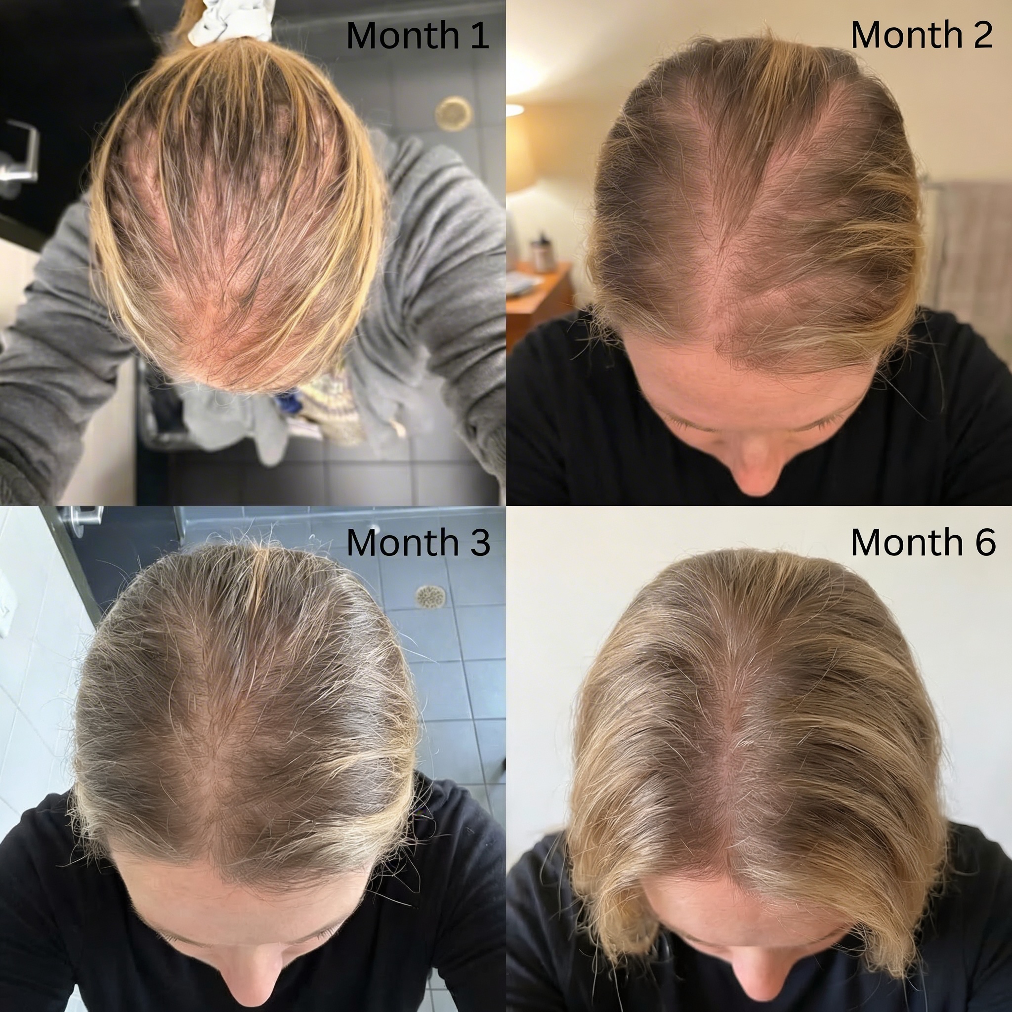 Hair regrowth results — week by week progress