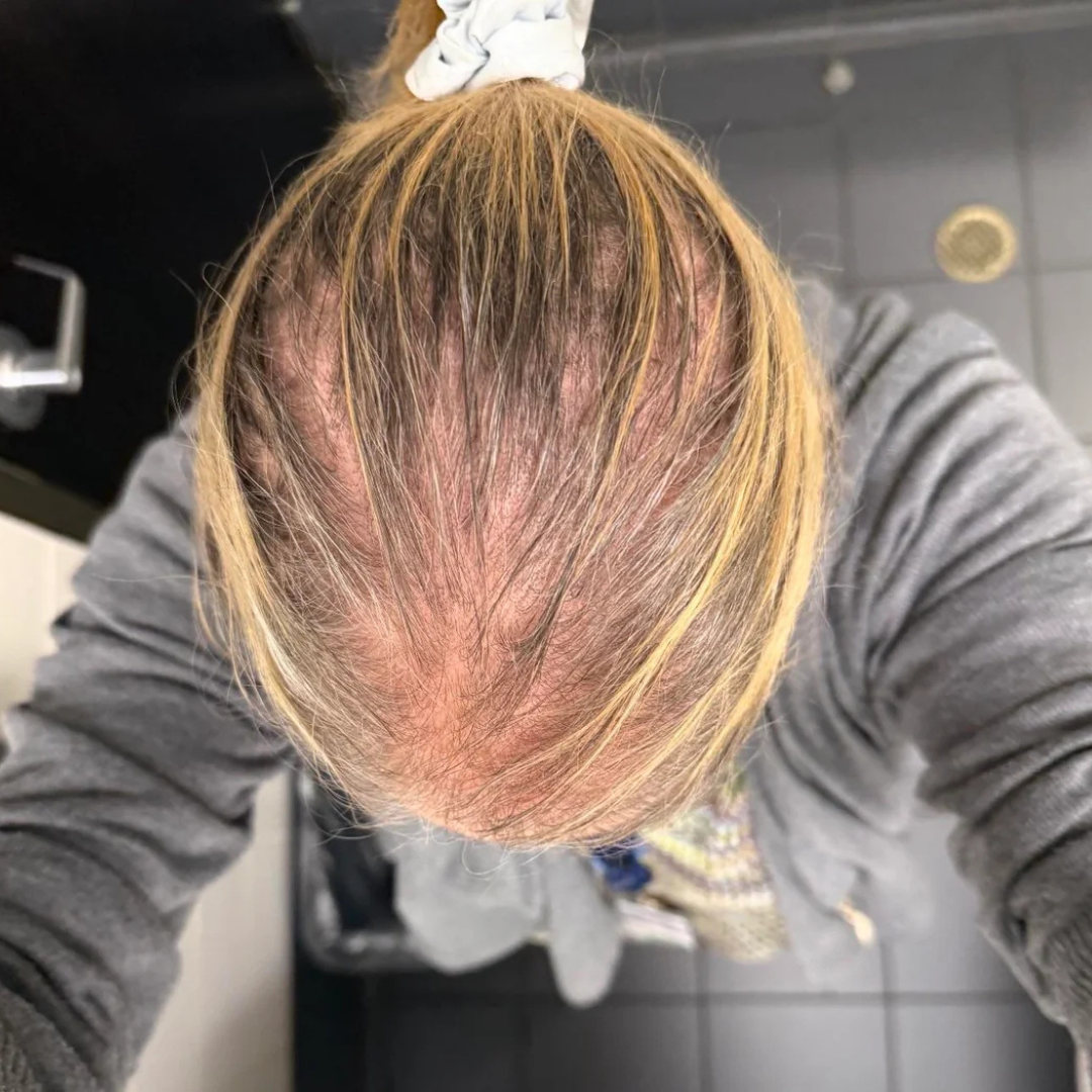 Thinning hair after weight loss